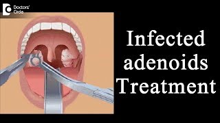 Treatment of infected adenoids in children  Dr Satish Babu K [upl. by Sokul]