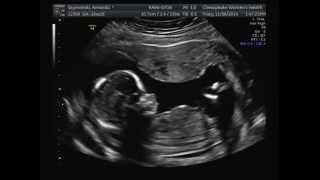 16 Weeks Pregnant Ultrasound [upl. by Fahland]