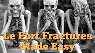 Le Fort Fracture Lines and Classification Type 1 2 and 3 Made Easy Quick amp EZ Episode 9 [upl. by Ahsiatal927]