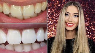 How I Whitened My Teeth at Home  Danielle Mansutti [upl. by Frieda630]