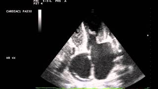 Infective Endocarditis  apical 4 chamber view [upl. by Assirrem]