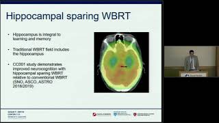 Study of WholeBrain Radiation vs Stereotactic Radiation for Patients with 520 Brain Metastases [upl. by Onitnas]