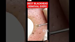 Best BLACKHEAD REMOVAL Ever  So Satisfying shorts [upl. by Eelame]