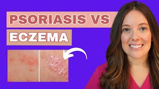 Do you Have Psoriasis or Eczema [upl. by Zilvia]