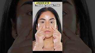 Transform YOUR Under Eye Hollow Instantly [upl. by Enaile247]