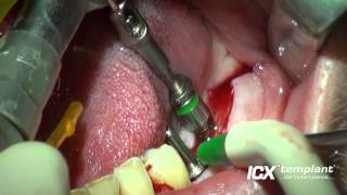 Dental Implantat Zahn 36 und 37 [upl. by Aratehs552]