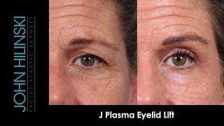 NonSurgical Eyelid Lift [upl. by Helbonnah]