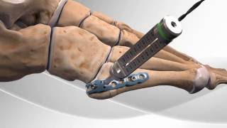 Metatarsal Fracture Repair with Arthrex® Hook Plate [upl. by Ytsenoh]