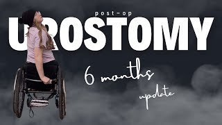 6 Months PostOp Urostomy Do I regret it [upl. by Brodie]