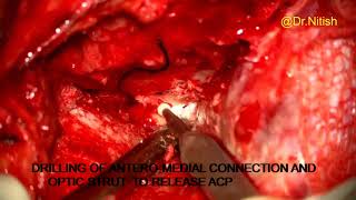 EXTRADURAL ANTERIOR CLINOIDECTOMY  OPTHALMIC ARTERY ANEURYSM CLIPPING [upl. by Alonso]