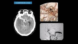 Imaging subarachnoid hemorrhage [upl. by Leede]