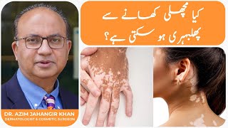 Leukoderma Bars PhulBehri Ka Jadeed laaj  Latest Vitiligo Treatment and Cure in Lahore Pakistan [upl. by Yttig]