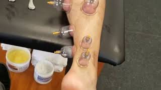 Graston Techniques and Cupping [upl. by Leavy206]