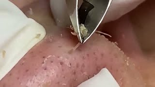 Tweezer Triumph Massive Nose Blackhead Removal [upl. by Gunilla]