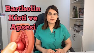 🔴 Bartholin Kisti ve Apsesi Nedir  Bartholin Kisti Nasıl Geçer [upl. by Gytle423]