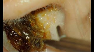 EAR WAX REMOVAL  MASSIVE PLUG  CAUSED HEARING LOSS [upl. by Airdnaid]