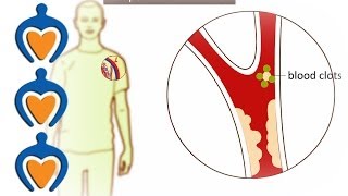 Thrombosis  What is it and how is it treated [upl. by Damien]