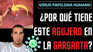 Increíble AGUJERO en la GARGANTA  Virus del PAPILOMA HUMANO [upl. by Nnylcaj]