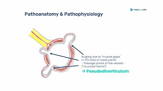 Diverticular Disease Diverticulitis  Introduction  Abdominal painAcute abdomen [upl. by Akessej]