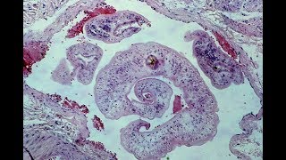 Schistosomiasis  Pathology mini tutorial [upl. by Assillam]