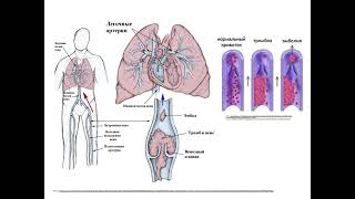 Thrombosis EmbolismViolations microcirculation [upl. by Novel]