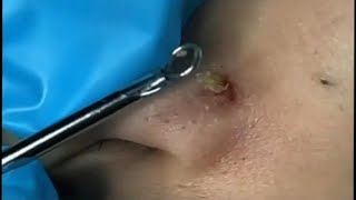 Big Cystic Acne Blackheads Extraction  Blackheads amp Milia  Whiteheads amp Comdones  Pimple Popping [upl. by Kilmarx]