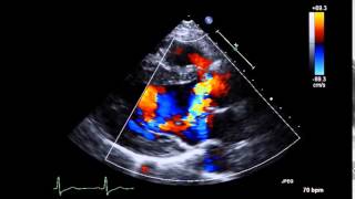 動画2 偏位のあるAR 経胸壁心エコー図、右冠尖の逸脱 [upl. by Dnomaj]