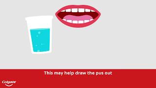 How To Treat a Gum or Tooth Abscess  Colgate® [upl. by Camilla681]