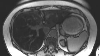 Hepatic Steatosis [upl. by Dnar960]