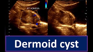 Understanding Dermoid Cyst  Guide to Ultrasonogram Diagnosis Ovarian Cyst  Practical Ultrasonogram [upl. by Janene]