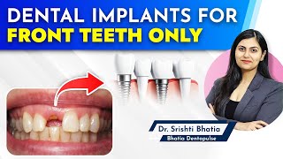 Dental Implants for FRONT TEETH only Dr Srishti Bhatia implants dentist newteeth [upl. by Leamiba]