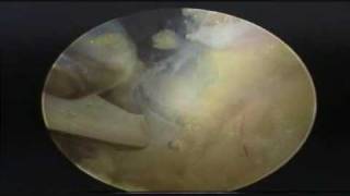 Arthroscopic Suprascapular Nerve Release [upl. by Garate]