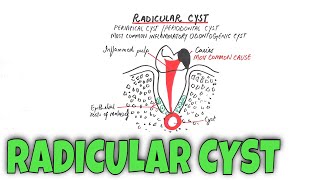 Radicular cyst  Periapical Cyst  Pathogenesis Clinical RF HF amp Treatment [upl. by Siblee436]