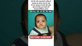 Cleft Lip and Palate Surgery at Saraswat Hospital at Agra [upl. by Dehnel]