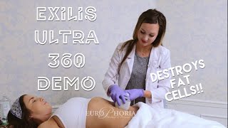 EXILIS ULTRA DEMONSTRATION BODY  Exilis Ultra 360 Experience at EuroPhoria [upl. by Asiak470]