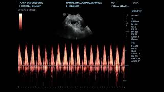 Frecuencia Cardiaca Embrionaria 10 SDG [upl. by Sileray]