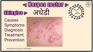 अधेडी  What is Herpes Zoster  Shingle  अधेड़ी का घरेलू उपचार  Herpes Zoster causes treatment [upl. by Endo115]