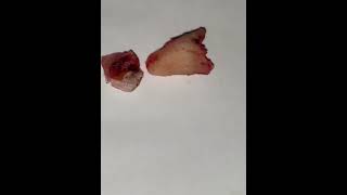 Wisdom extraction umairtoothfairy dentalsmile umairazeem viral shorts Umairazeem8553 [upl. by Freemon800]