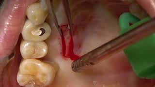 Mixed EpithelialConnective tissue graft harvesting from palate [upl. by Edme998]