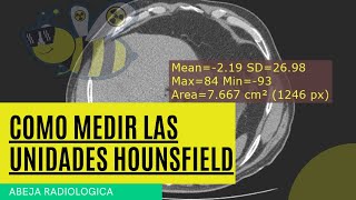 🔺📏📒COMO MEDIR LAS UNIDADES HOUNSFIELD ❓❓ [upl. by Rochette]