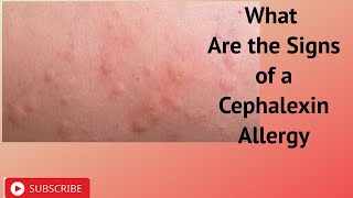 What Are the Signs of a Cephalexin Allergy [upl. by Auston411]