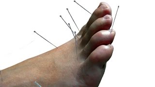 Gout Treatment Acupuncture  Laser [upl. by Aivax]