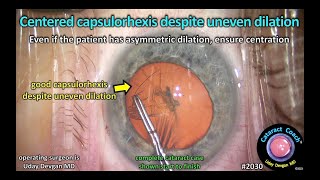 CataractCoach™ 2030 centered capsulorhexis despite uneven dilation [upl. by Dougald]