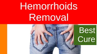 Hemorrhoids Removal [upl. by Mahala]