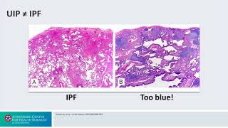 Evaluation and Diagnosis A Usual Interstitial Pneumonia  Interstitial Lung Disease [upl. by Ermentrude]