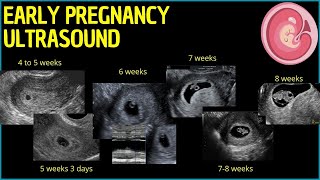 Early Pregnancy Ultrasound A Deep Dive into First Trimester Insights pregnancyultrasound [upl. by Ayerf317]