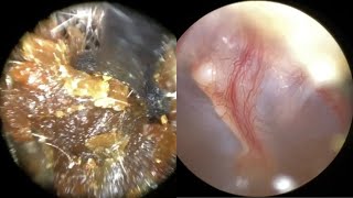 139  Severe Ear Wax Blockage Removed using WAXscope®️amp New Mechanical Instruments [upl. by Patrica]