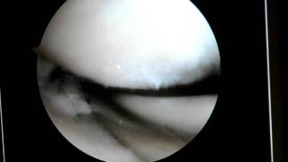 Dr Robert Eppley Arthroscopic Knee Surgery Video  3 [upl. by Eldwin]