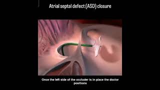 Atrial Septal Defect ASD USMLE Step 1 Pathophysiology [upl. by Batory592]