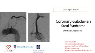 Subclavian coronary steal syndrome [upl. by Morris]